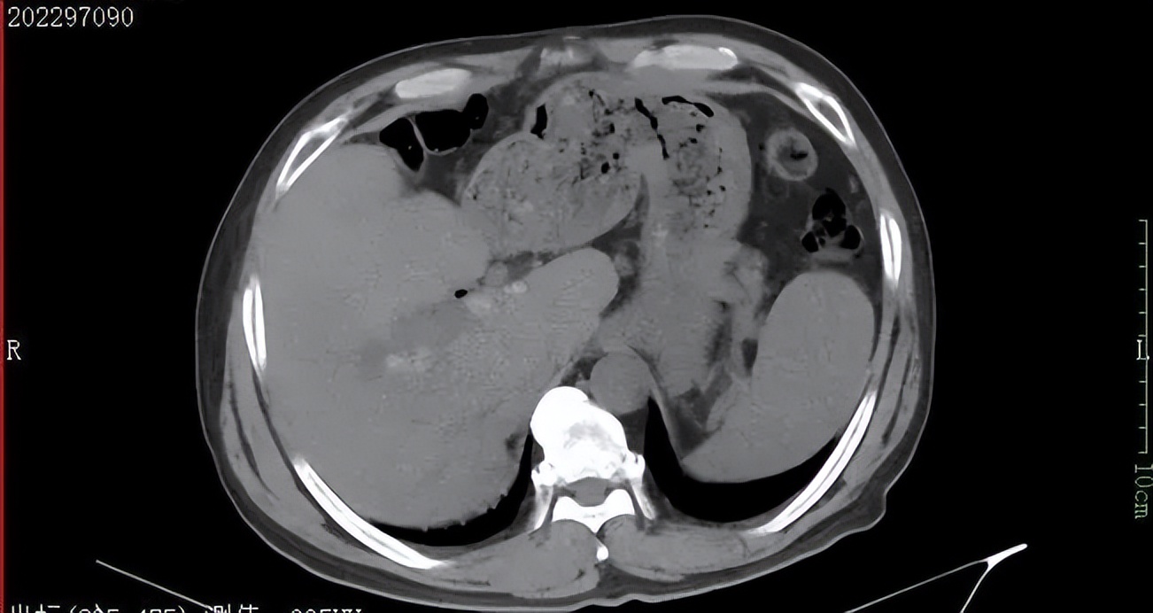 肝内胆管结石微创取石恢复快吗,一男子从胆囊取出几百个结石