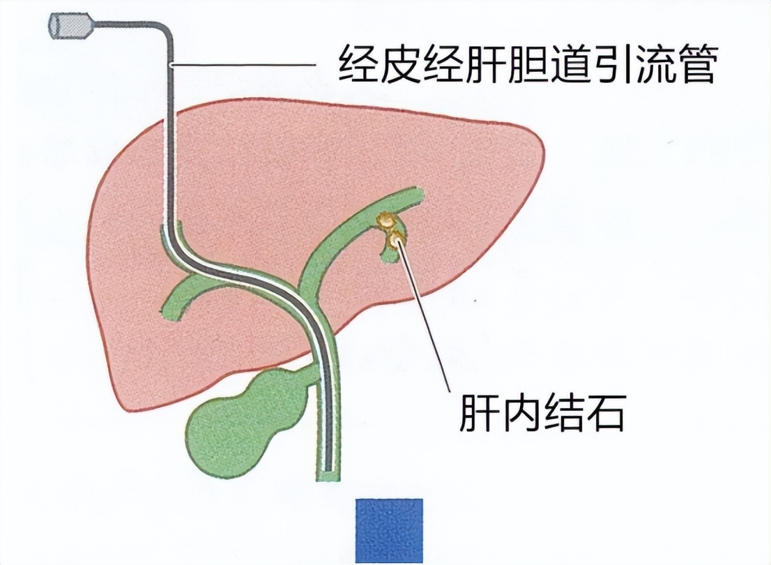 急性胆囊炎发作的原因有哪些,急性胆囊炎的症状及治疗都有哪些