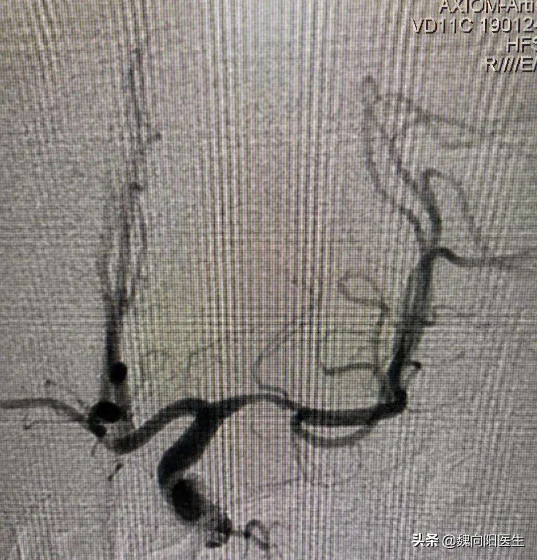 血管狭窄引起脑卒中需要下支架吗,脑动脉狭窄脑梗死后遗症严重吗