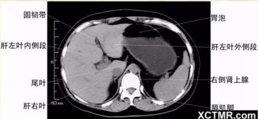胸腹部盆腔ct主要检查什么,女性盆腔ct断层解剖结构图