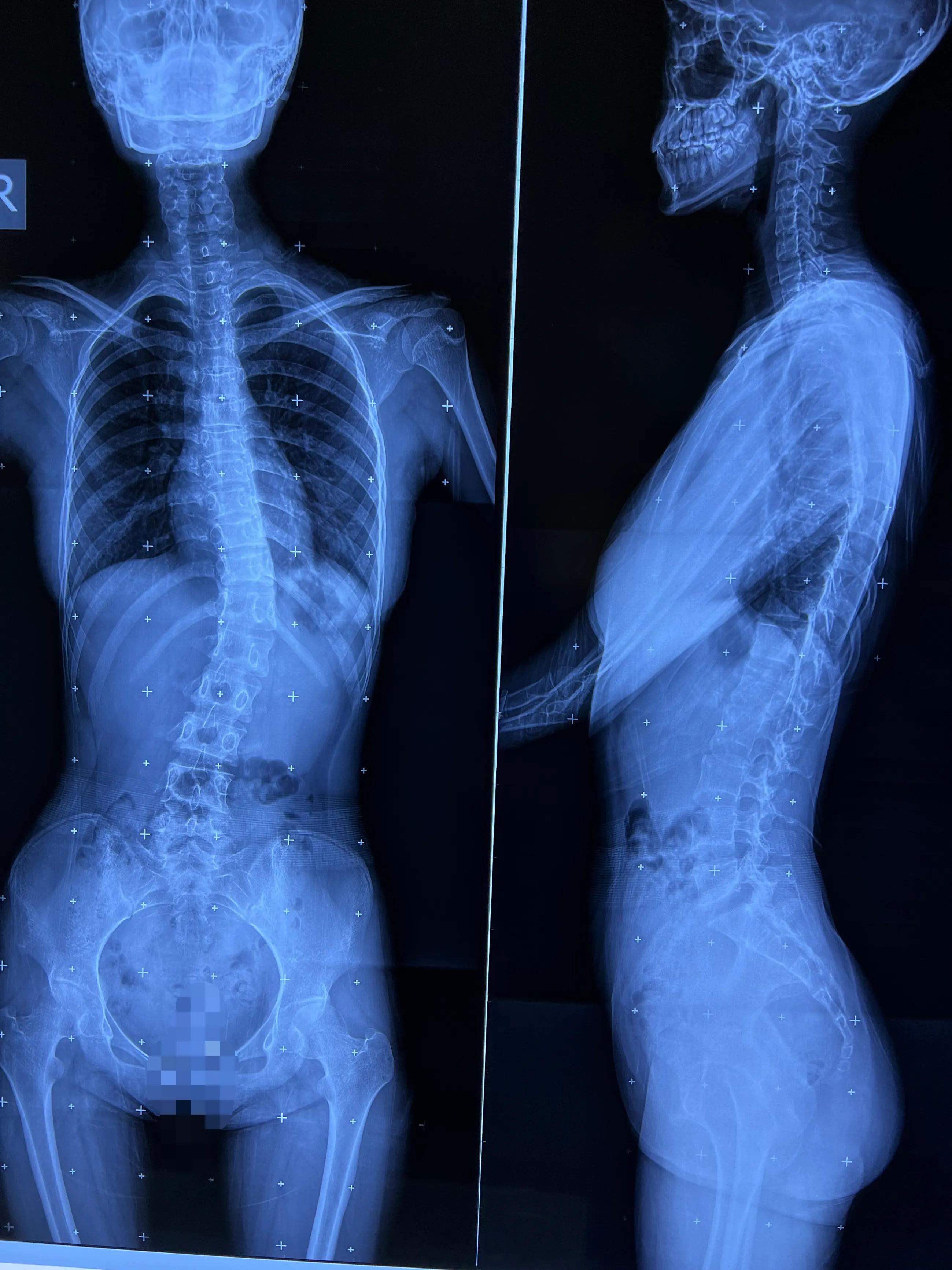 5岁有一点点的脊柱侧弯,学生脊柱侧弯筛查对身体有影响吗