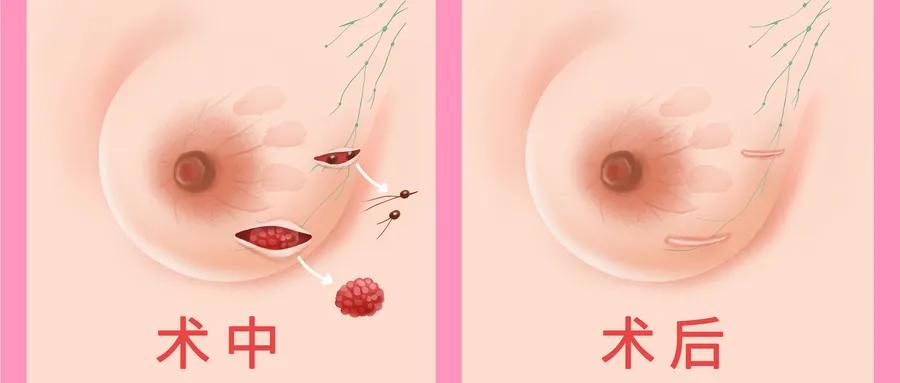 早期乳腺癌也要切除乳房吗,乳腺癌早期治疗要切除乳房吗