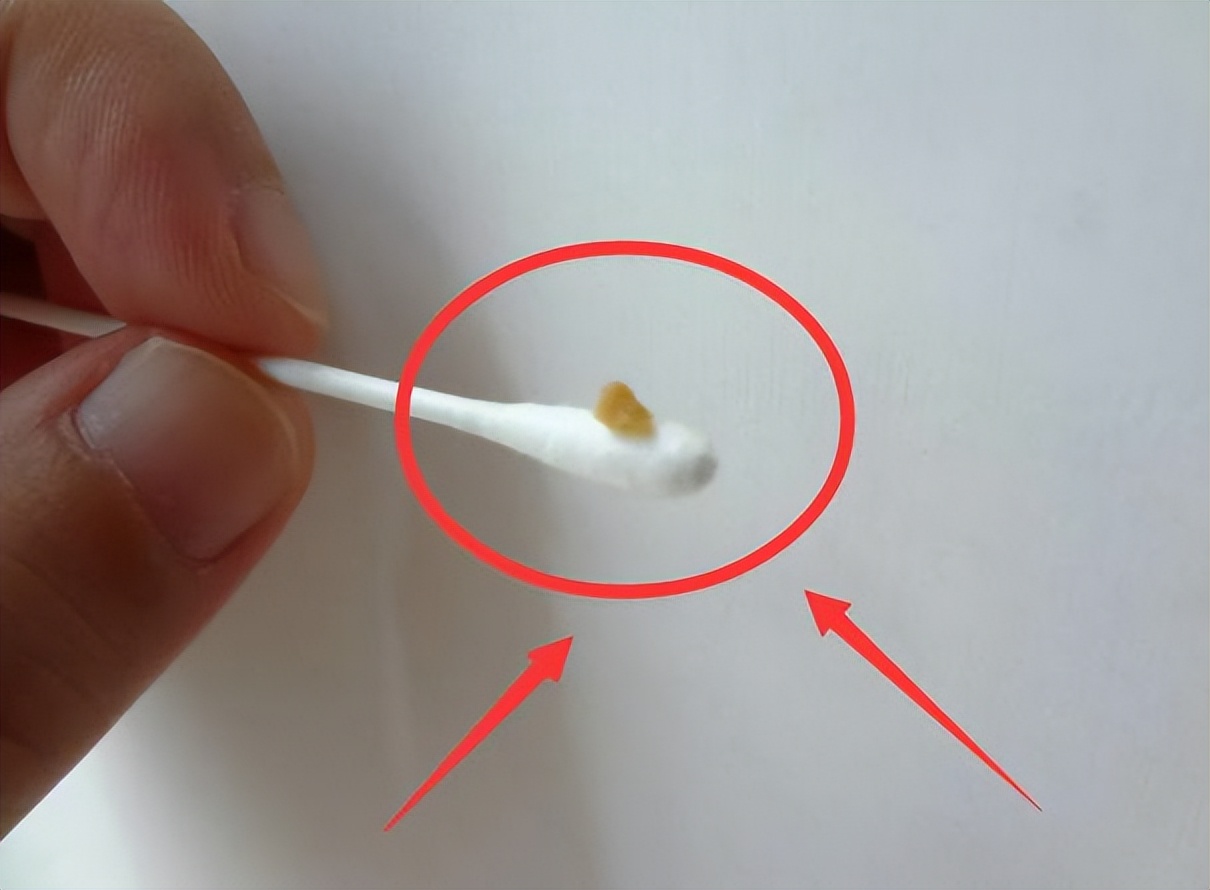 为什么有的人是油耳,糠耳与油耳的区别