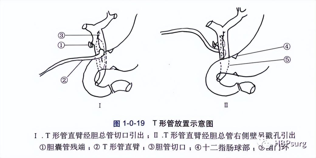 关于肝胆管结石治疗的入肝途径的总结