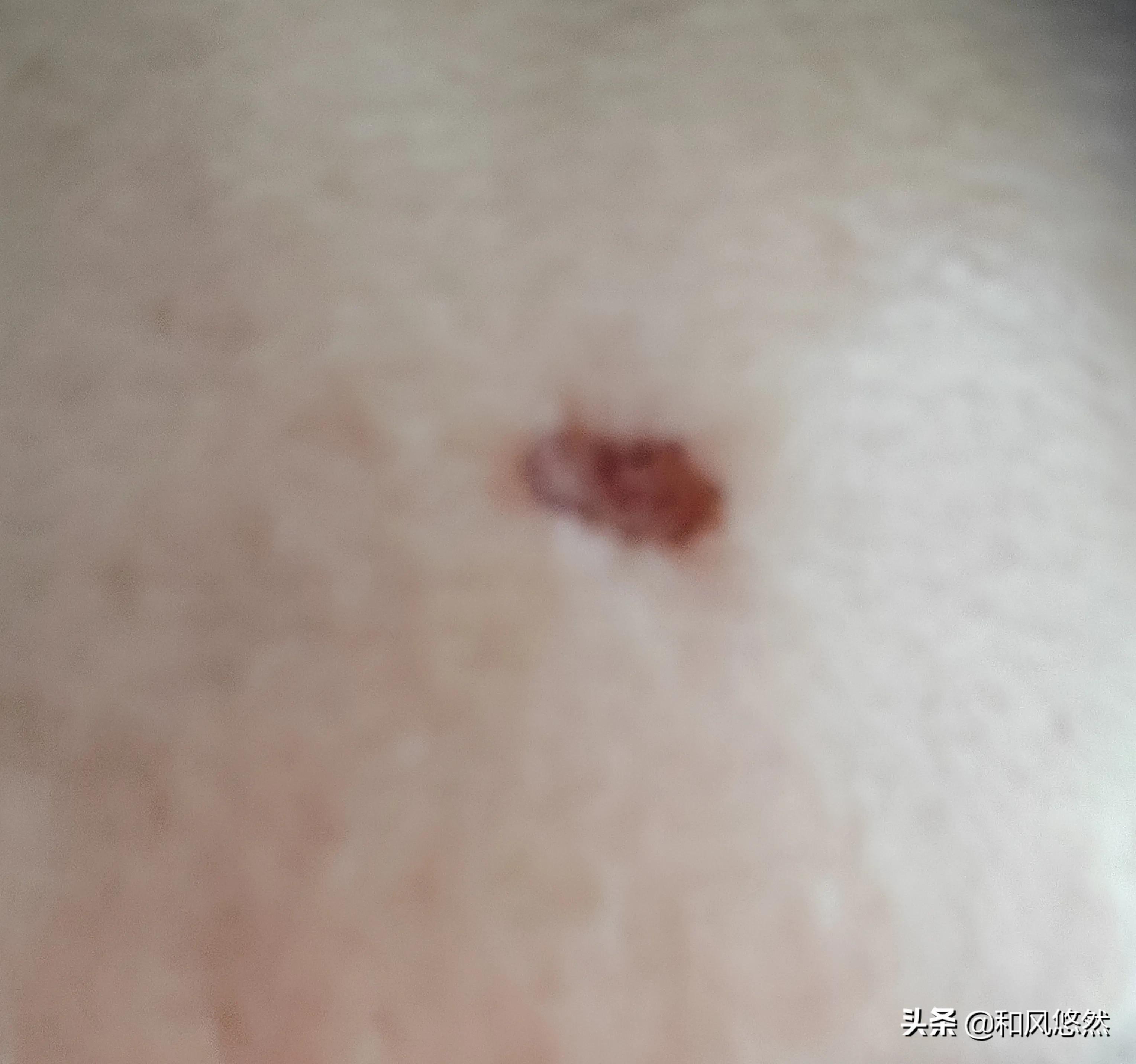 祛斑真实有效推荐,快速祛斑易出现哪些副作用