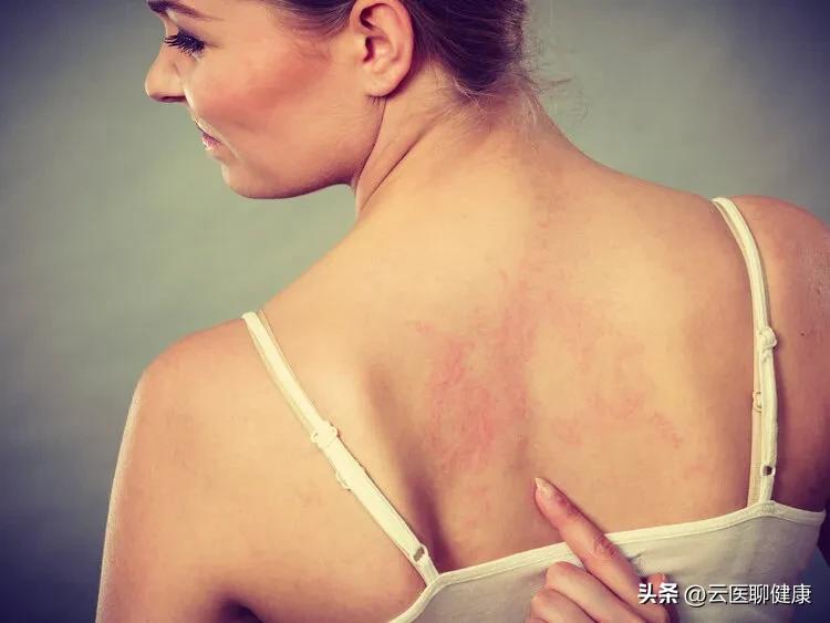 荨麻疹是什么原因引起的分几种,麻疹致病机理