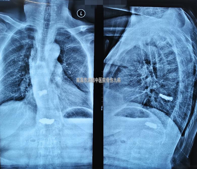 打个喷嚏导致腰椎骨折视频,打个喷嚏全身骨折视频