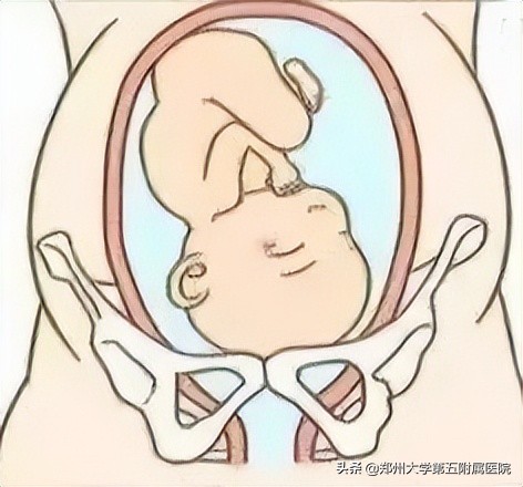 胎位不正？看郑州大学五附院产科团队如何让宝宝“华丽转身”