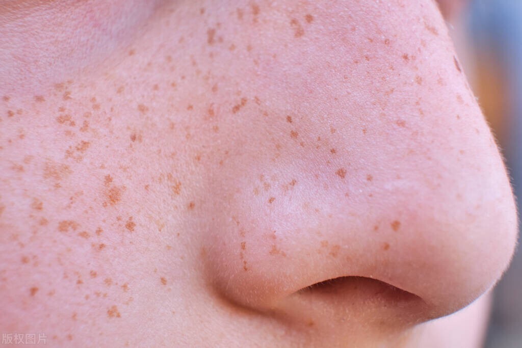 什么是顽固性雀斑,什么是雀斑跟晒斑