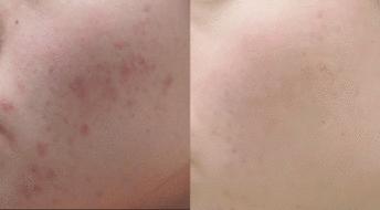 最全祛痘方法针对各种痘痘,有什么办法祛痘不会反反复复