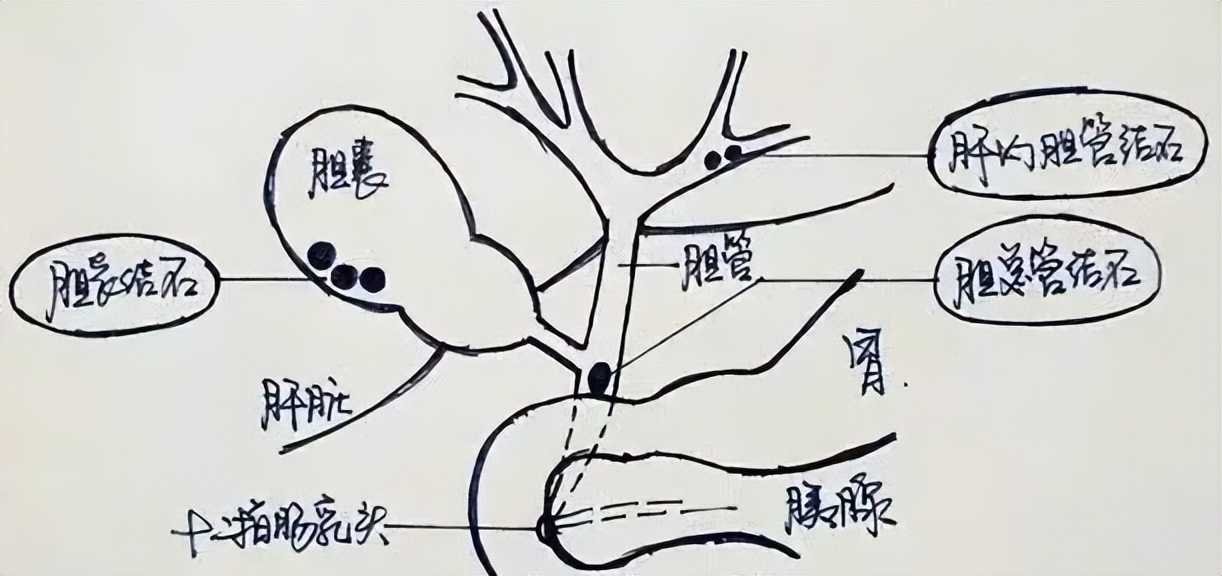 胆结石很小的时候医生说不用处理,胆结石不痛的情况下需不需要治疗