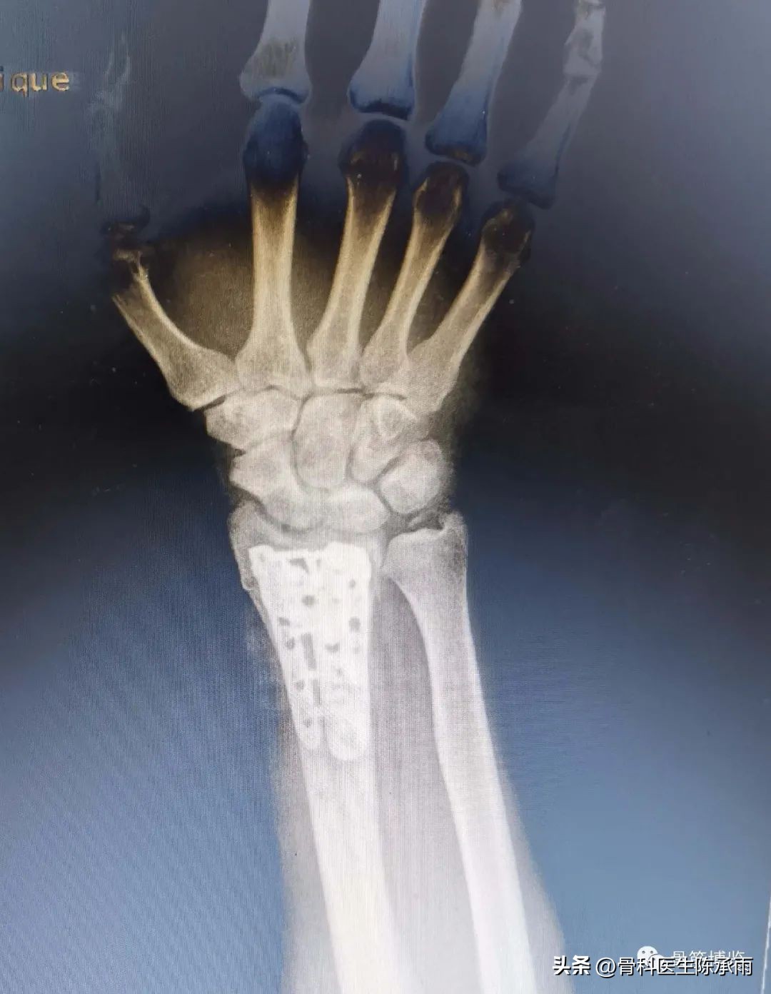 桡骨远端骨折伸直型的复位及固定,掌骨骨折外固定支架恢复