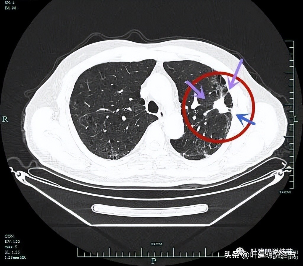 pet判断淋巴结转移,petct判断癌有没有转移准确吗