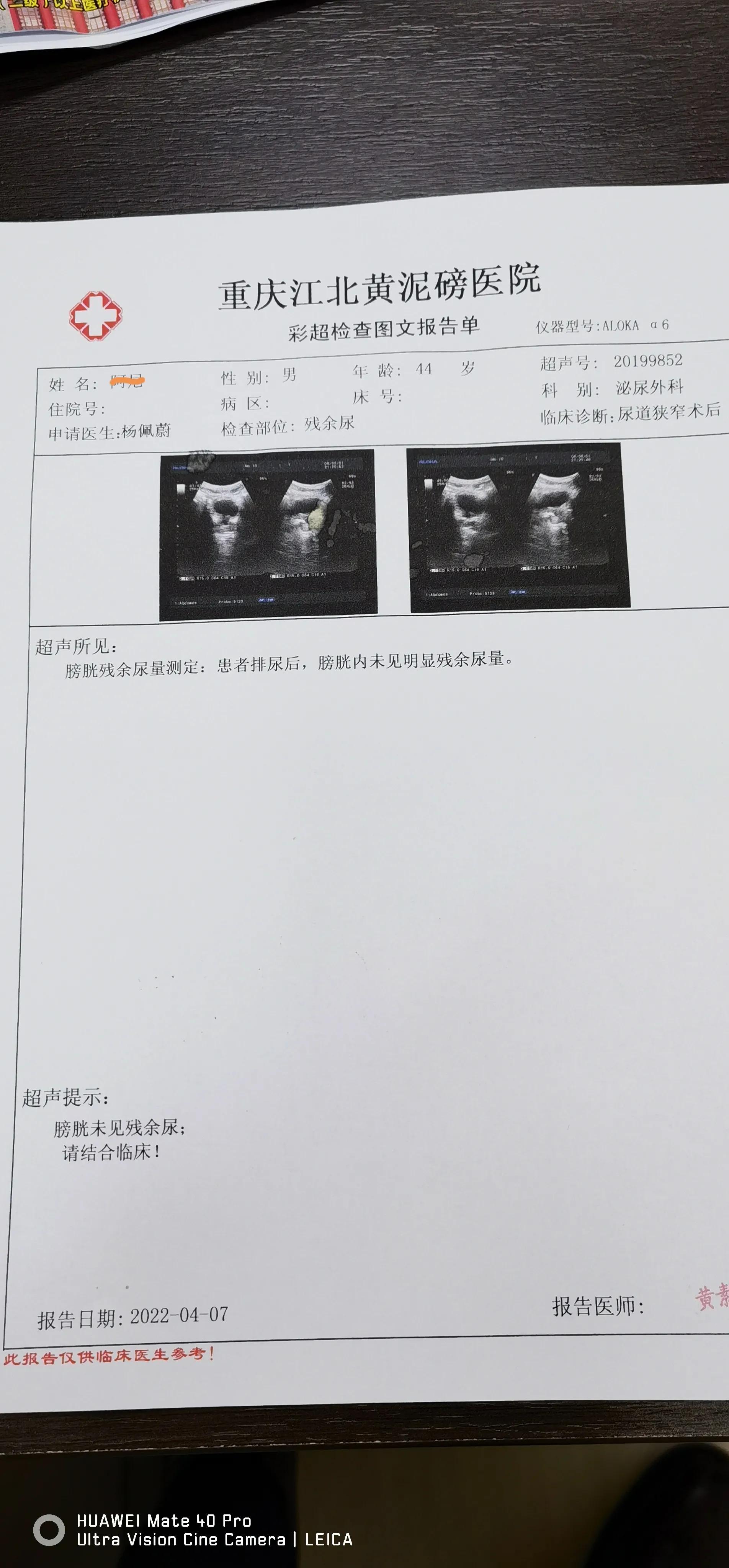 尿道闭锁能手术治愈吗,微创手术治疗尿道闭锁
