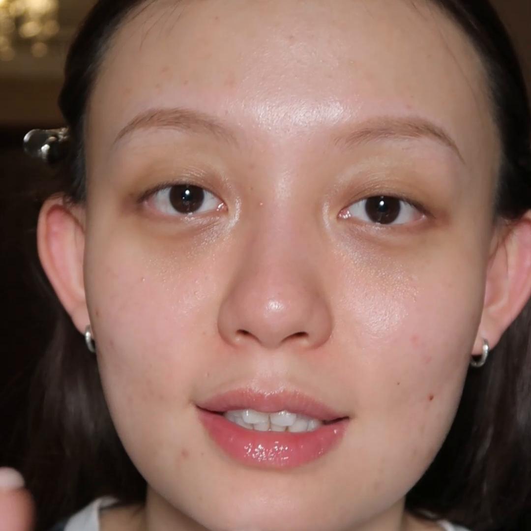 痘肌祛闭口的最好方法,闭口混合痘肌如何护肤