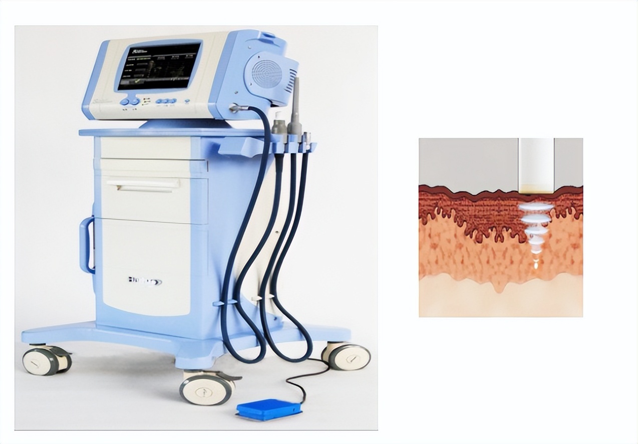 超声聚焦治疗宫颈炎出血怎么办,治疗宫颈出血微创