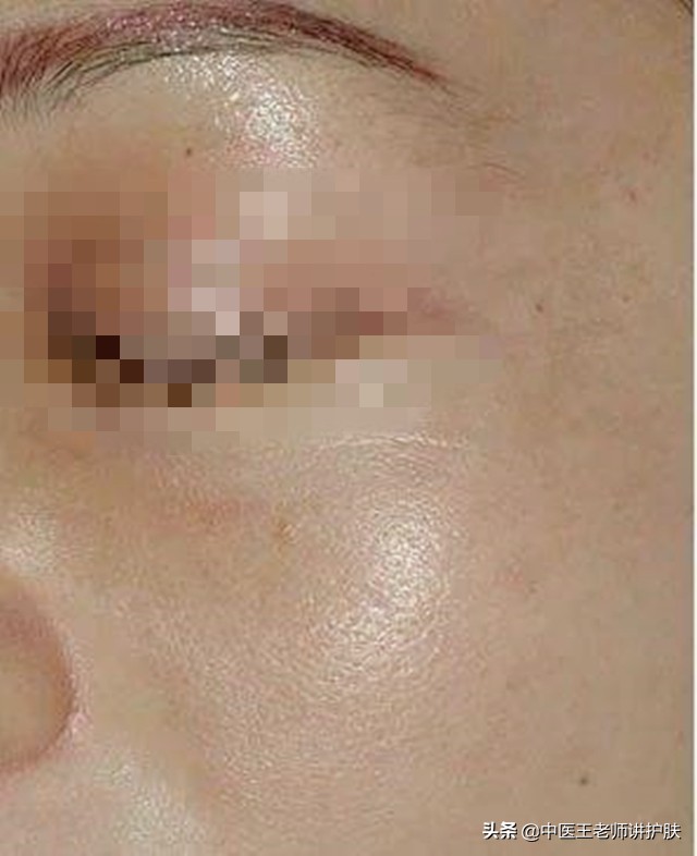 肝肾阴虚长斑怎么去掉,女人肝肾虚长斑怎么治