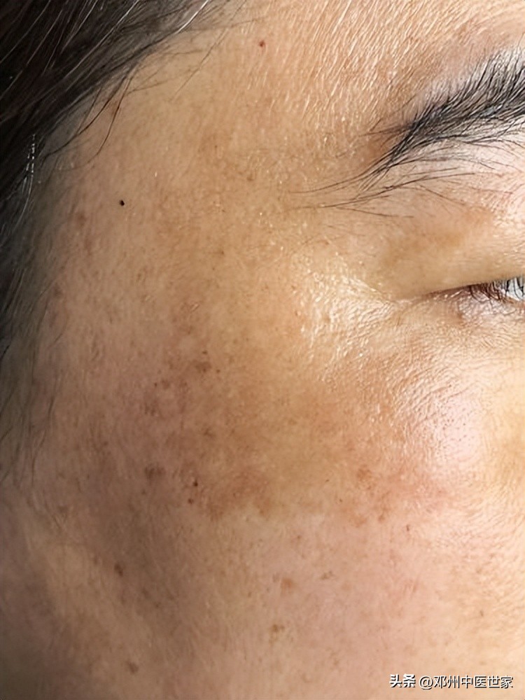 根治面部黑褐斑的方法,脸上的褐斑属于雀斑吗