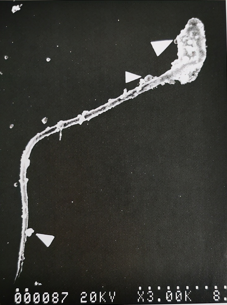 uu感染是什么意思,uu感染严重吗