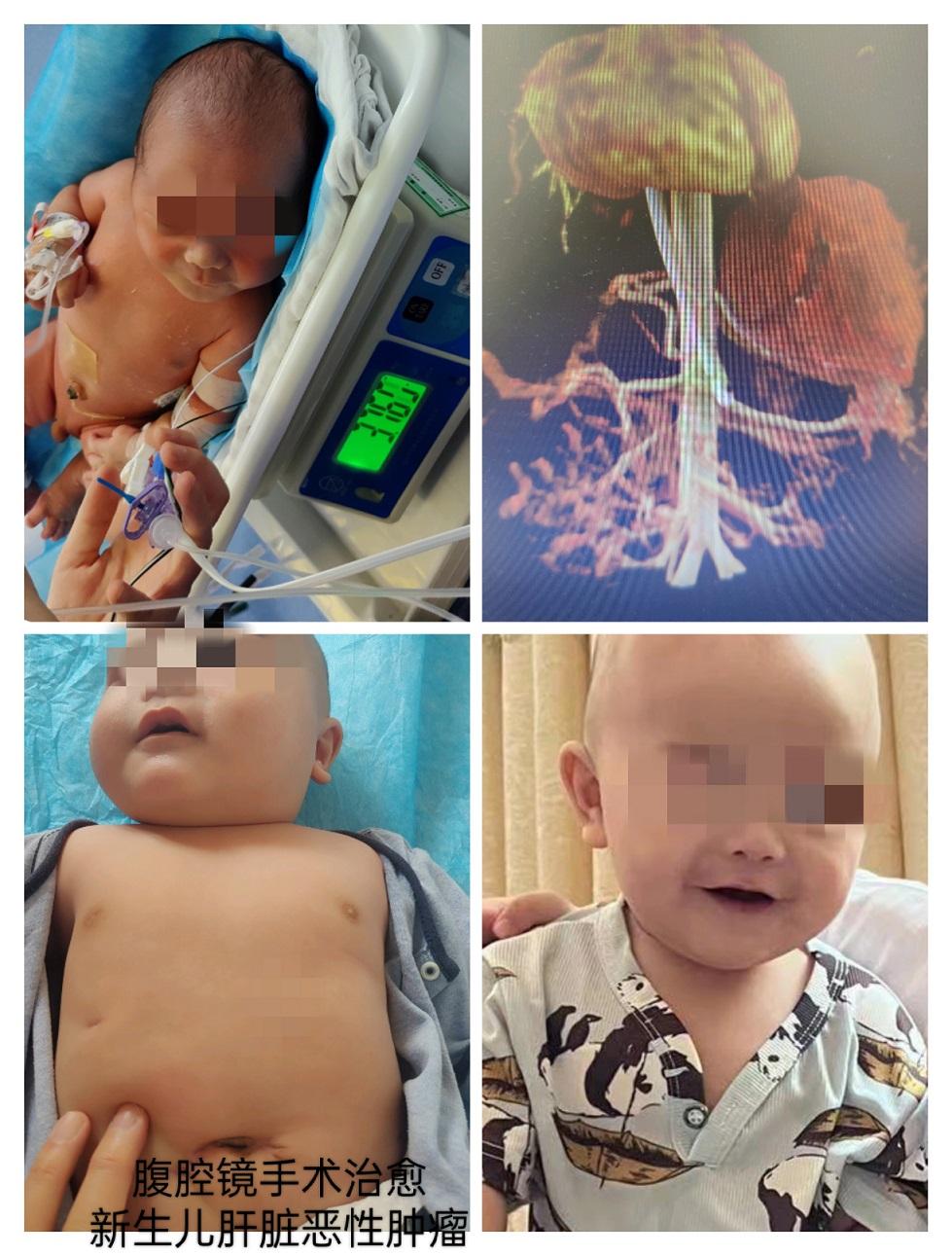 市妇幼成功完成全国最小新生儿微创肝脏肿瘤切除术