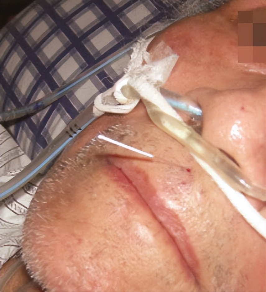 脱三针以脉复汗止、肢暖、清醒为度，主治中风脱证