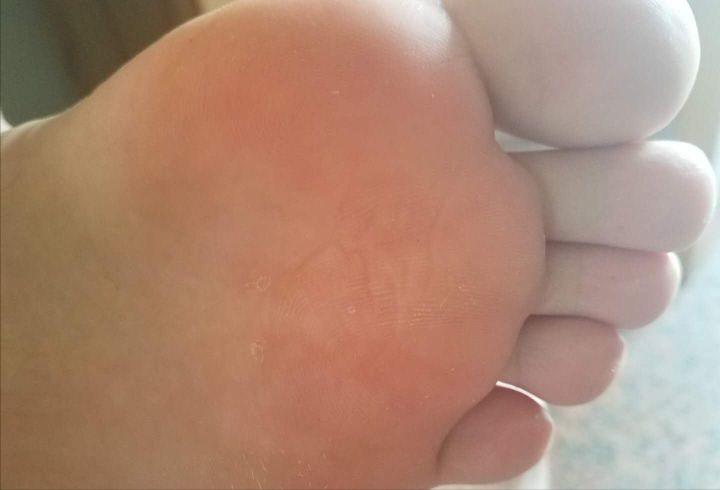 手足疣痊愈过程,跖疣治疗经验分享