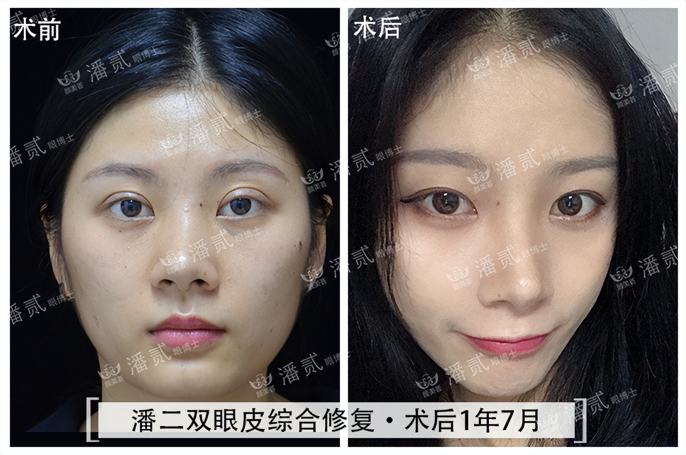 双眼皮贴导致眼皮破了,双眼皮贴导致眼皮严重下垂恢复