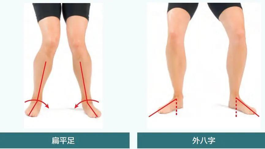 改善腿型让腿变直的鞋,腿不直穿什么鞋子掩盖缺陷