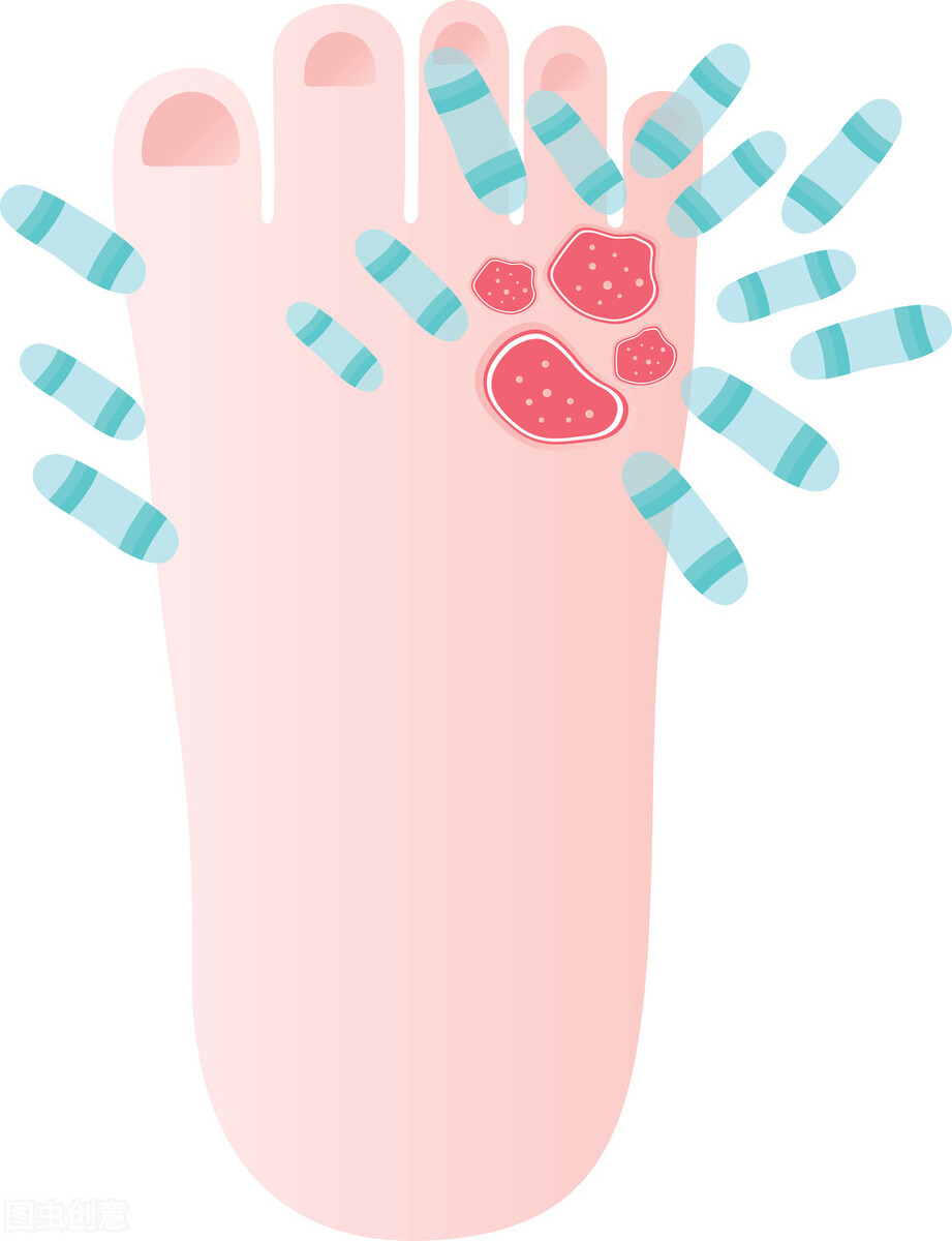 脚气总是反反复复教你一招,脚气反反复复如何才能根治