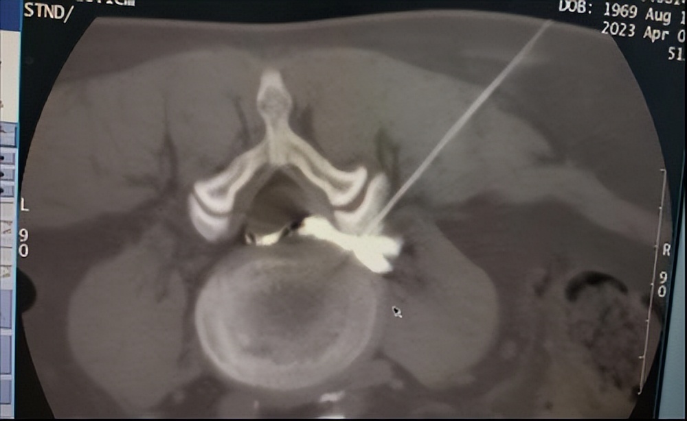 「绵阳」九三学社员张静率针灸康复疼痛团队利用“微创”技术让老百姓挺起腰杆