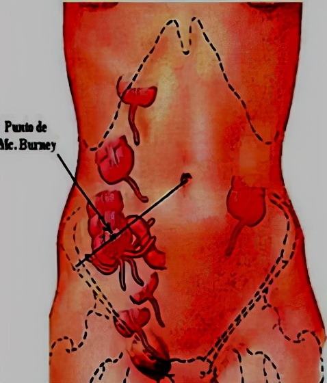 怀孕早期发现有阑尾炎怎么办,怀孕得阑尾炎怎么办胎儿能要吗