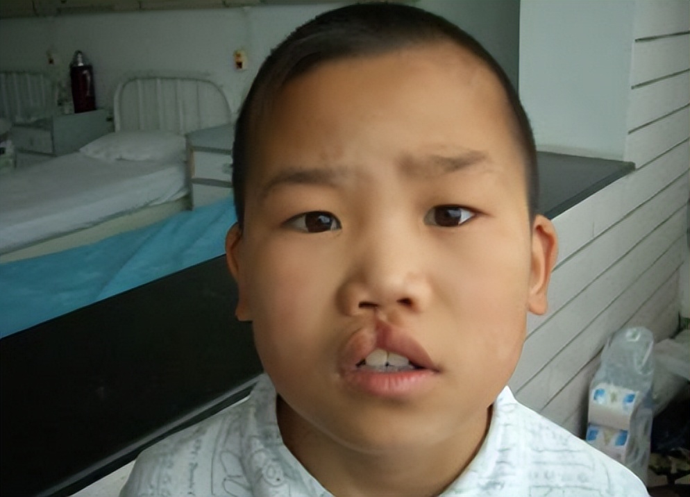 婴儿唇腭裂怎么护理,唇腭裂麻醉