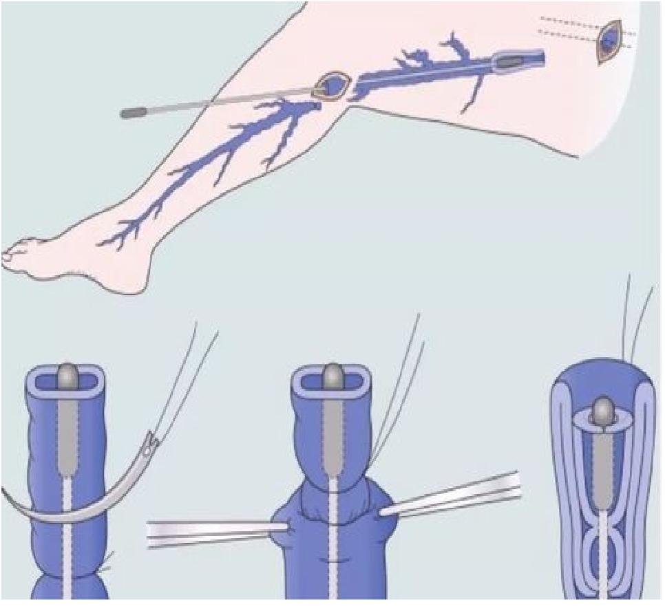 比微创介入更高级的手术,血管万能胶