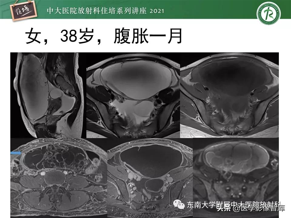 卵巢浆液性肿瘤的肉眼及镜下特征,卵巢原发性粘液性囊腺瘤