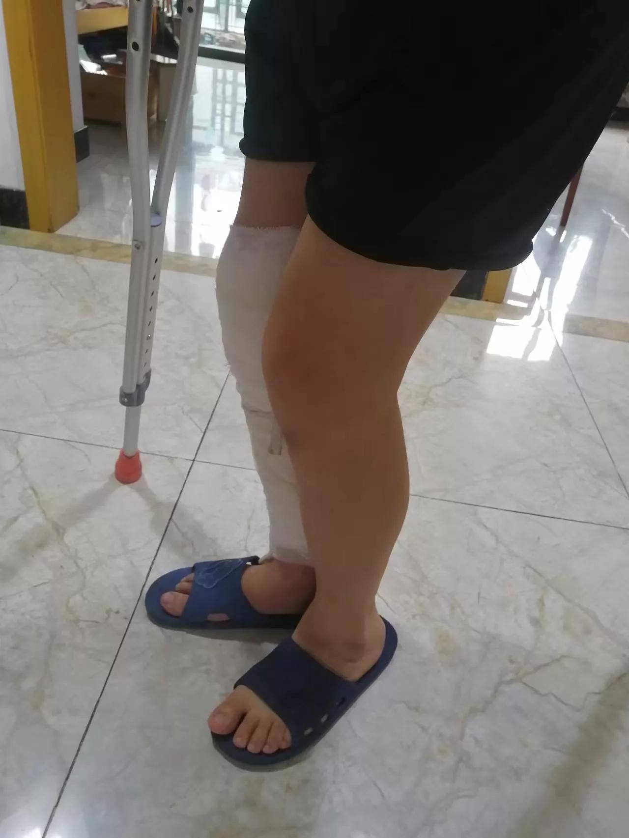 膝盖骨折不能弯曲最迟多久锻炼,骨折后膝盖僵硬无法弯曲怎么办