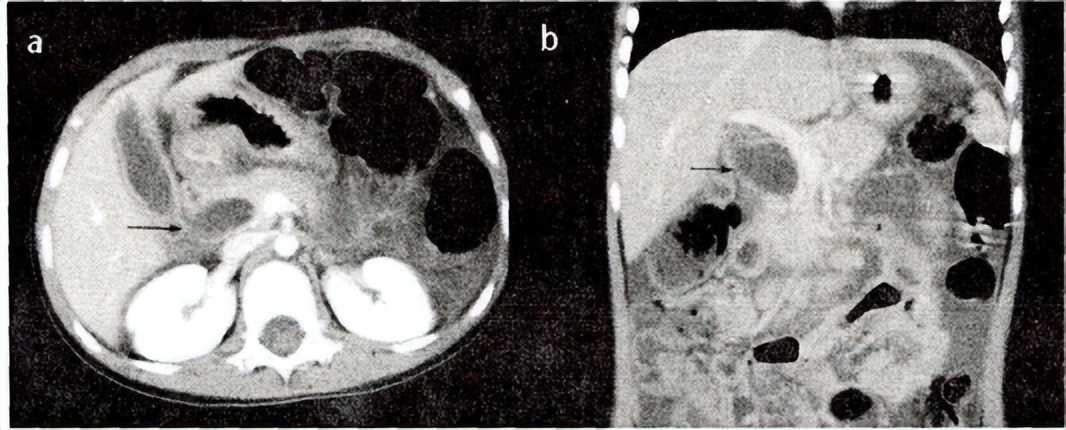 胰胆管合流异常影像诊断,基于影像组学的深度学习