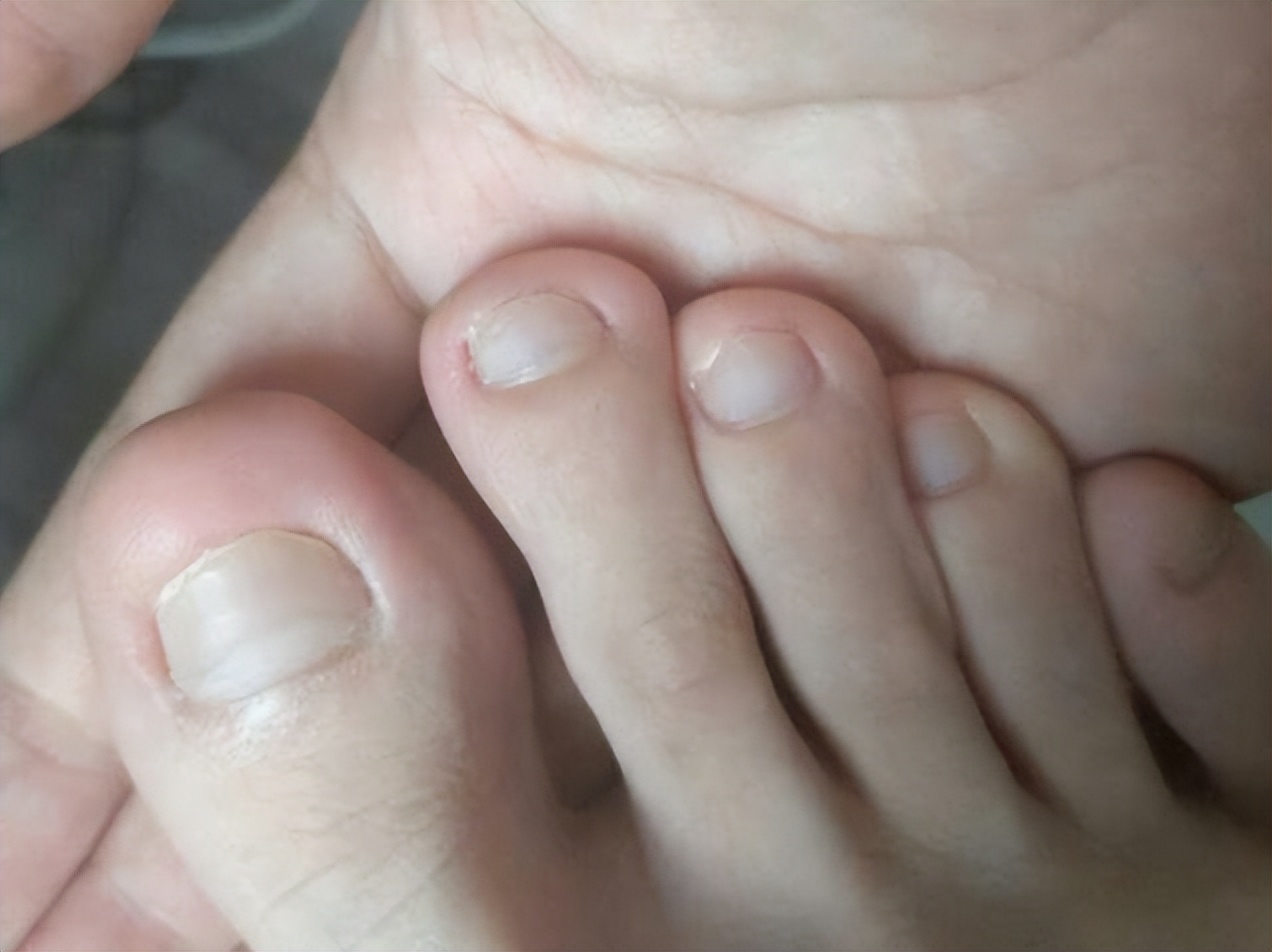 学会这3个小方法，在家轻松摆脱灰指甲！