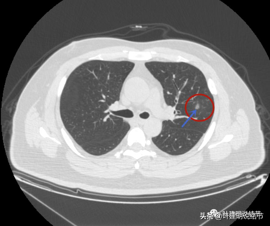 如何判断肺磨玻璃结节是高危结节,肺上有混合磨玻璃结节要注意什么