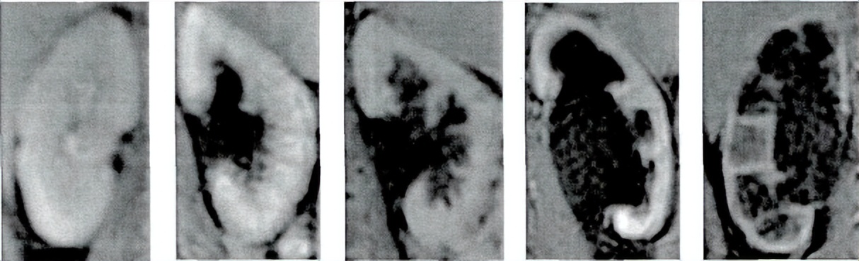 中医治疗宝宝肾积水输尿管狭窄,小儿肾积水和输尿管扩张怎么治疗