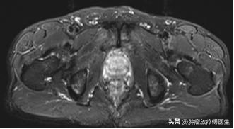前列腺癌psa8,前列腺癌内分泌治疗psa降低至2.75
