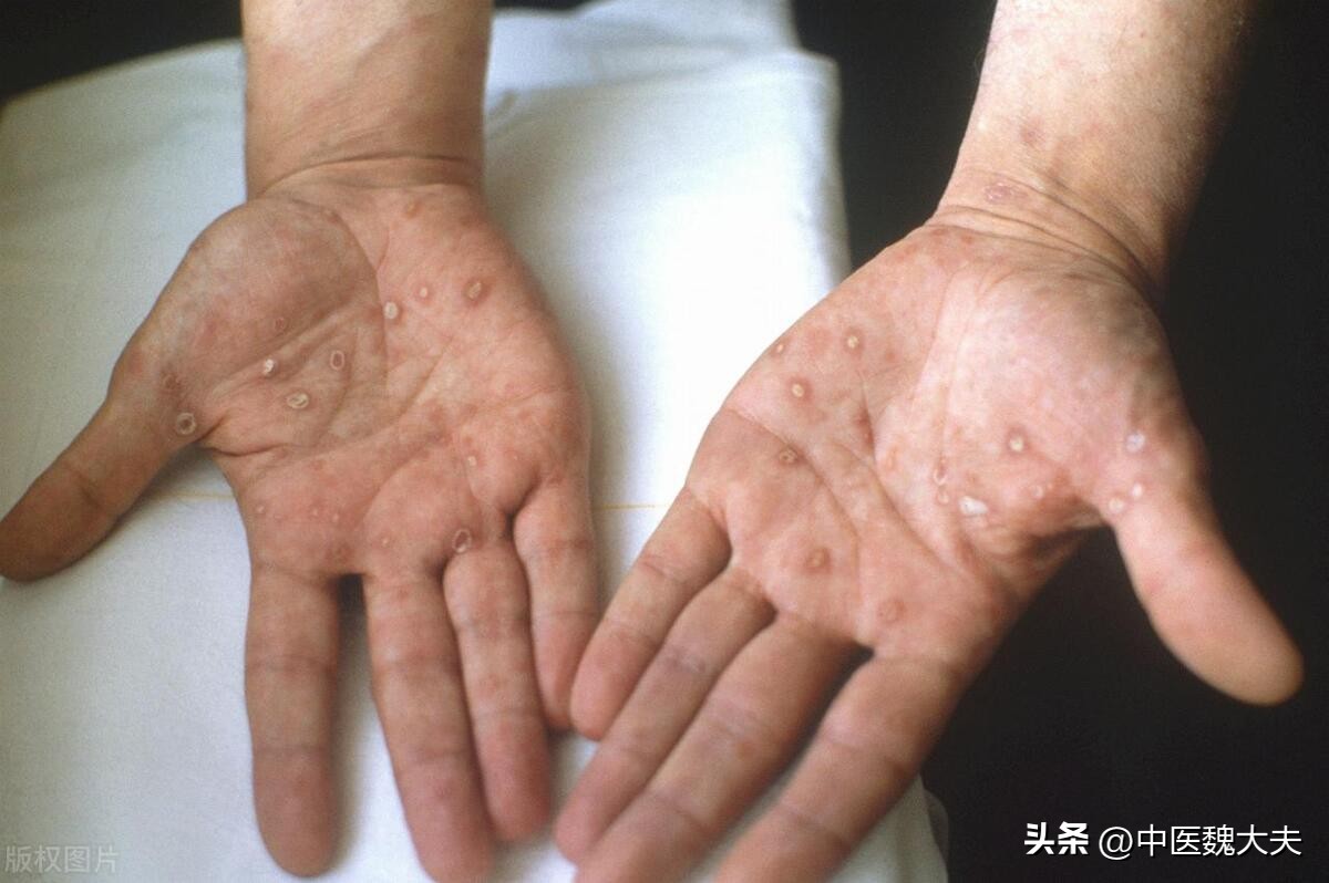 梅毒是因为脚气导致的吗,梅毒脚气用什么药效果最好