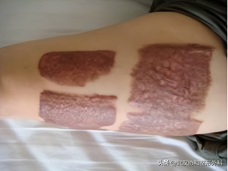 扩张器到底是什么？了解一下