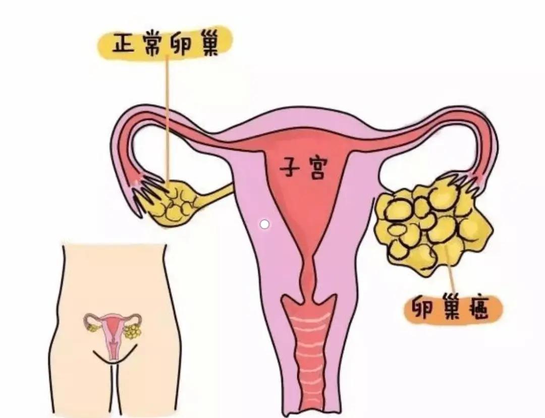 专家解答:卵巢癌患者化疗后需要靶向治疗吗?