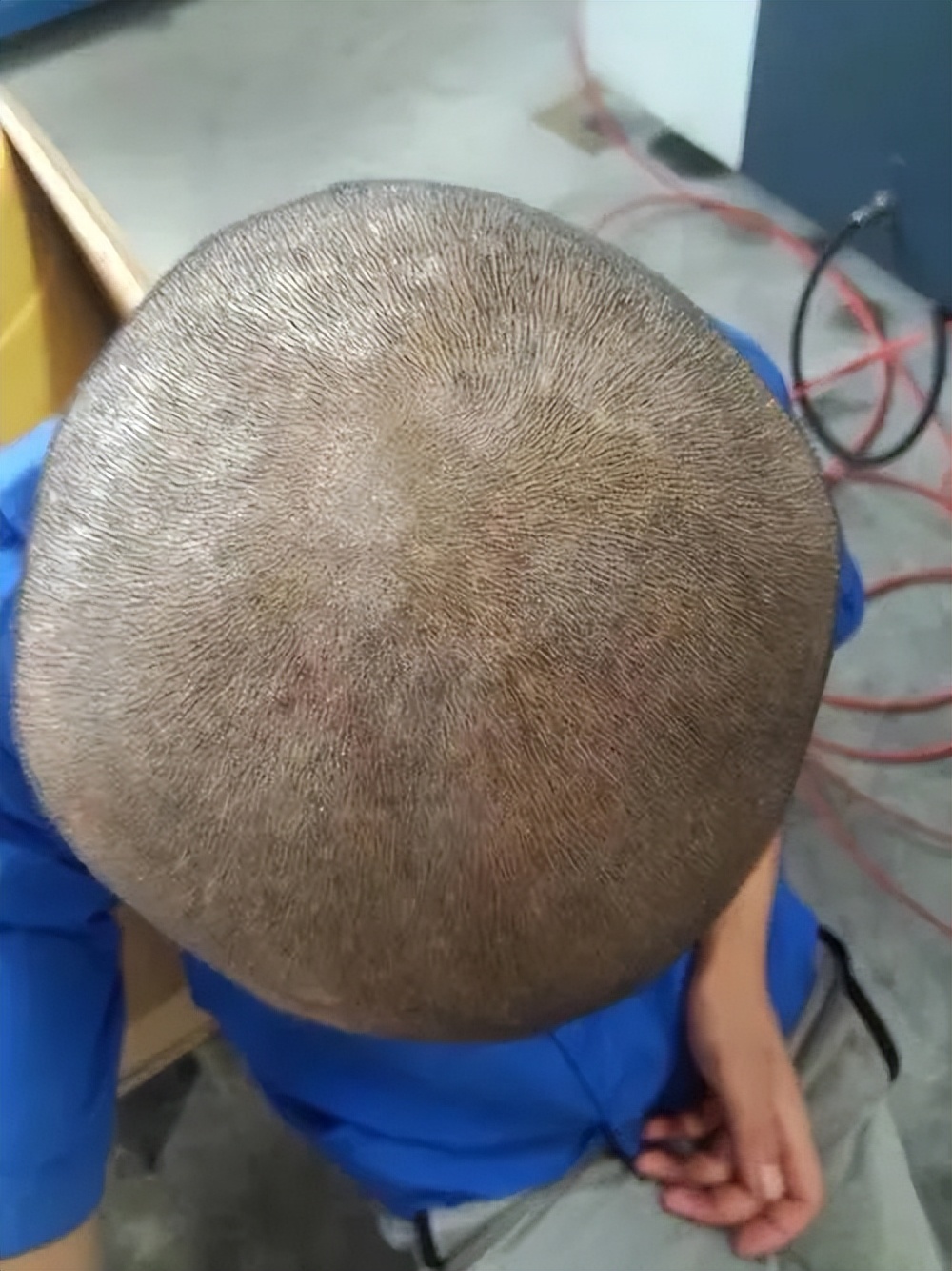 银屑病头皮屑症状中医,银屑病为啥头皮鳞屑厚