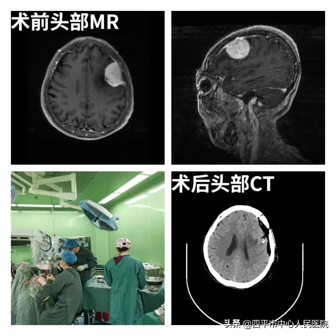 脑肿瘤治疗最新技术,治疗脑肿瘤的靶向药有哪些