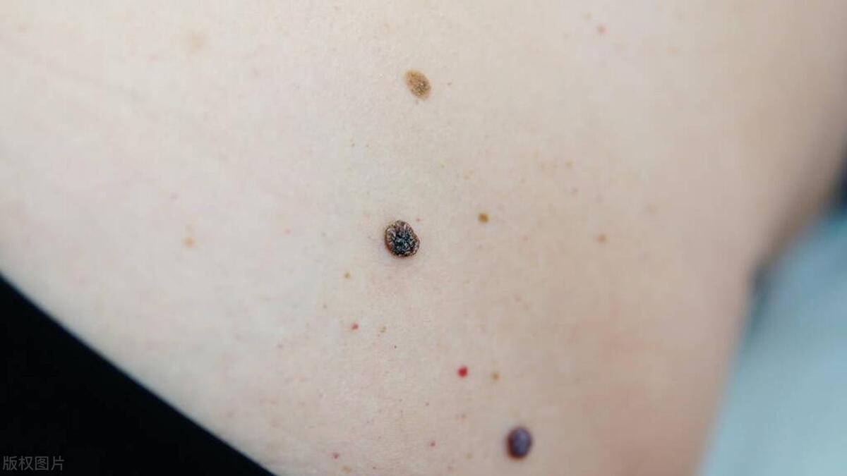 脂肪瘤中医消除最快方法最简单,中医消除脂肪瘤最好的绝招