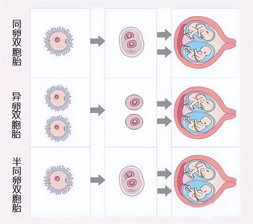 排出两三个卵能否生双胞胎,26岁女子查出双子宫