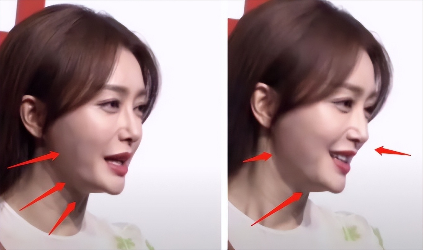 哪些明星整容后遗症越来越严重,整容明星后遗症对比图片