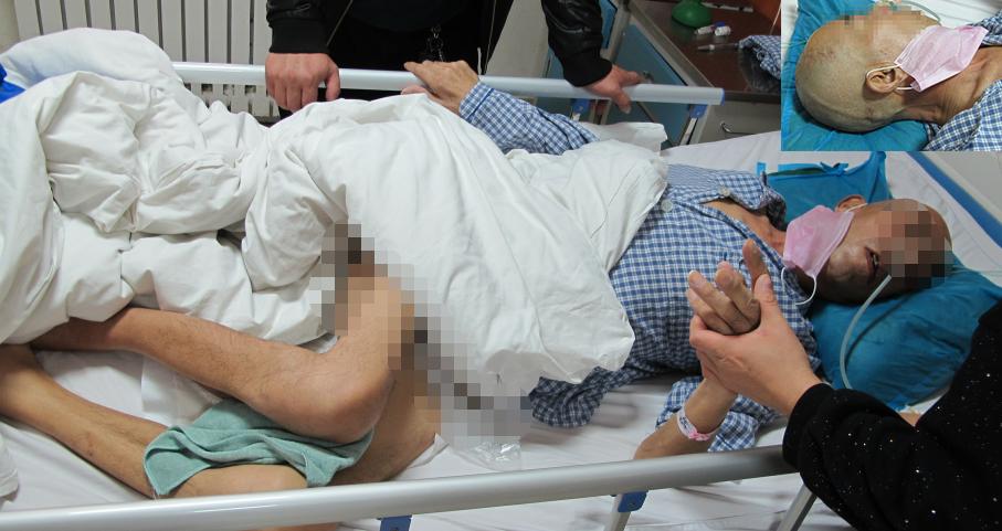 脑外伤后硬膜下积液颅骨修补,颅骨修复手术失败导致脑积水