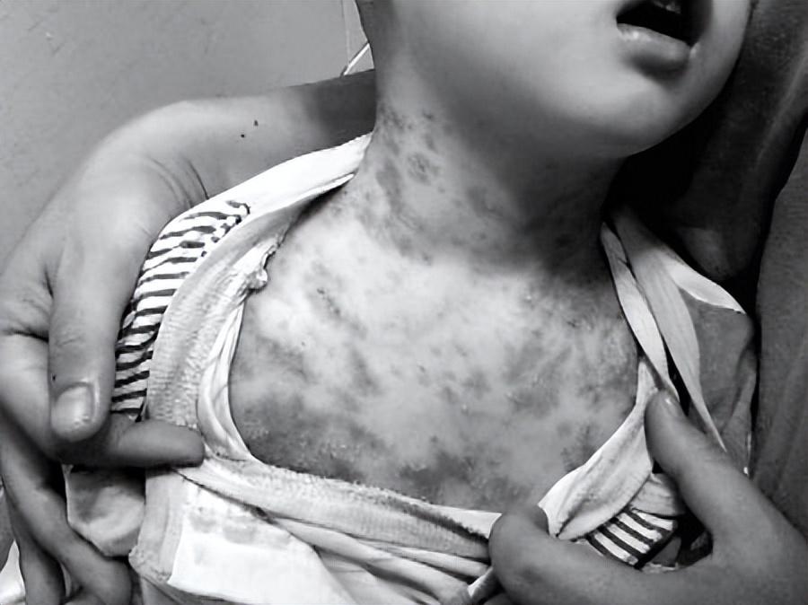 宝宝湿疹反反复复给她安排了药浴,婴儿去湿疹泡药浴用什么药比较好